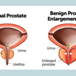 Fibroadenoma of breast or benign breast tumors or breast lumps