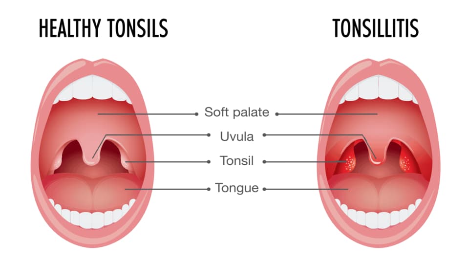 Best Homeopathic Medicines For Tonsillitis Homeopathic Specialist