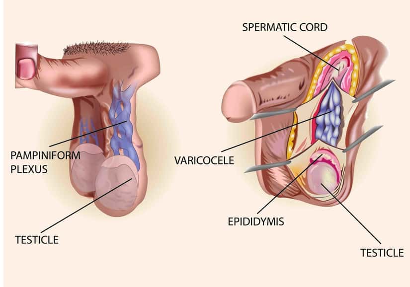 5 best homeopathic medicines for varicocele that help avoid surgery