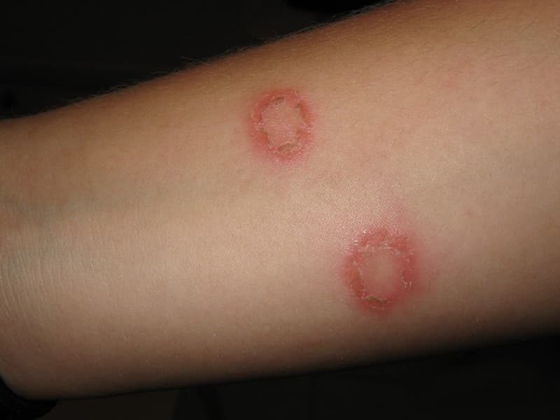 Best Home Remedies For Ringworm | Femina.in